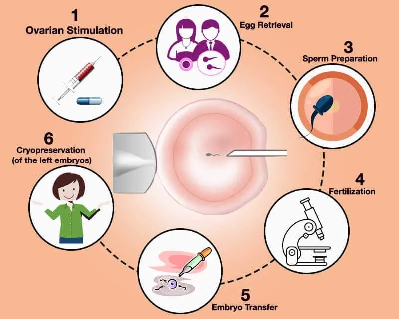 ICSI Treatment 6-Step Clinical Cycle Infographic from Ovarian Stimulation to Cryopreservation